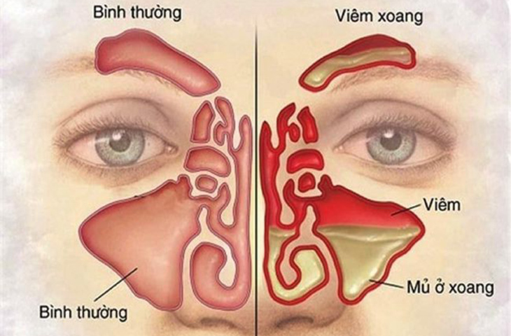 Viêm xoang và những điều cần biết