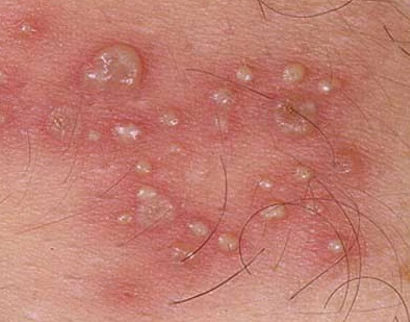 nguyên nhân khiến cậu nhỏ nổi mụn trắng không ngứa là gì? 5 tại sao cậu nhỏ nổi mụn