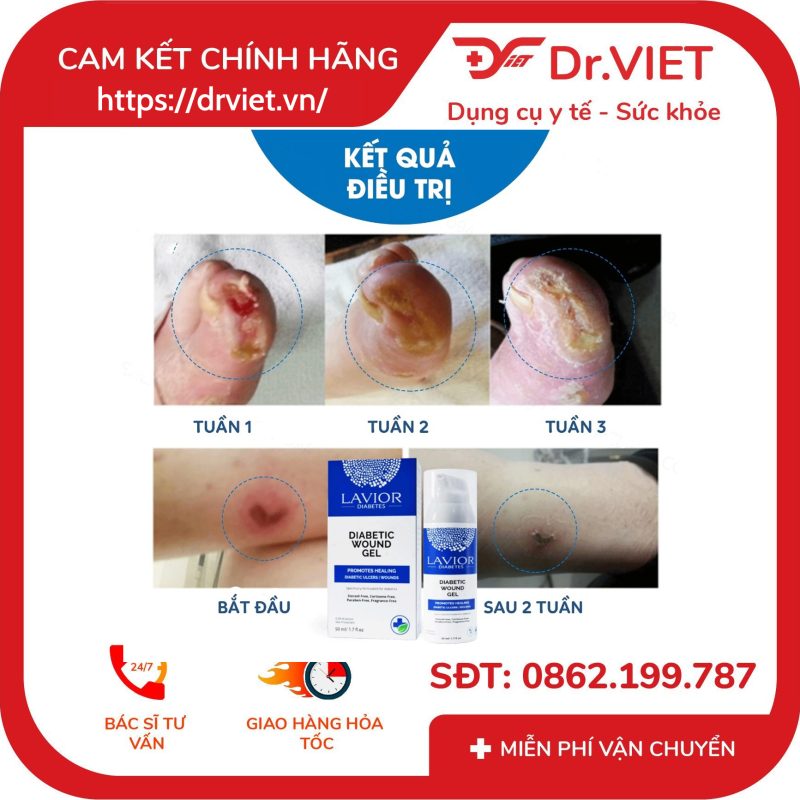 Gel chống loét tiểu đường Lavior D-Care Diabetic Wound Gel 50ml