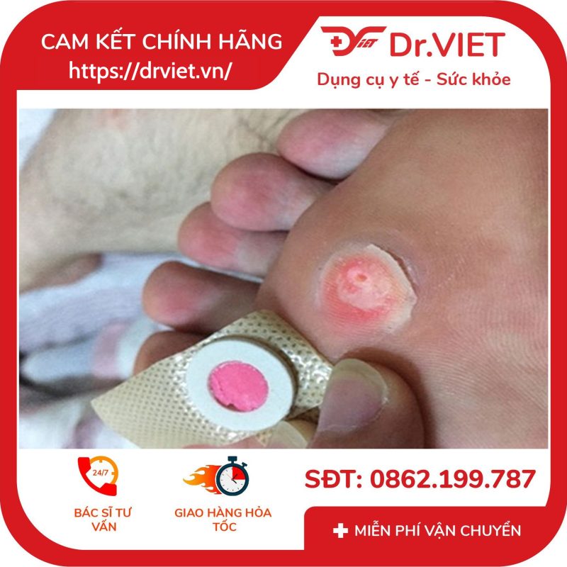 Alternative view of Miếng dán ngoài da Plaster trị mụn cóc