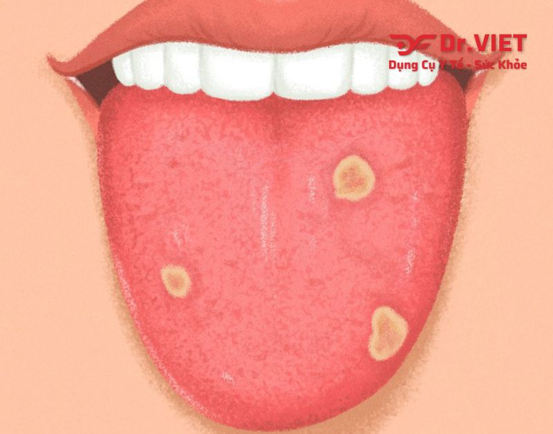 sùi mào gà ở lưỡi và những dấu hiệu nhận biết khi mắc bệnh sùi mào gà! 5 Cách chữa sùi mào gà ở lưỡi tại nhà