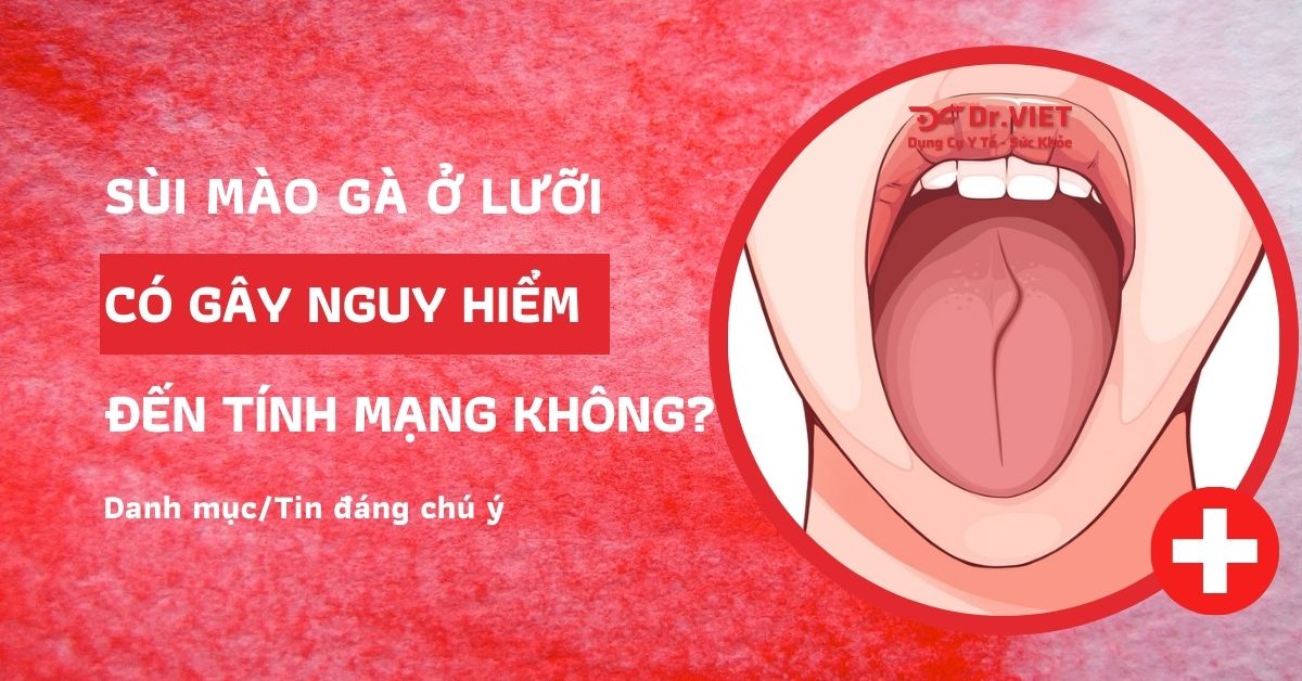 Sùi mào gà ở lưỡi